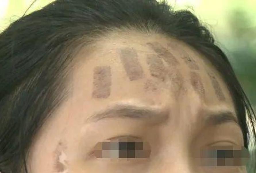 成都光子嫩膚價(jià)格，科技重塑肌膚之美